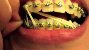 Muscatura corecta aparat dentar